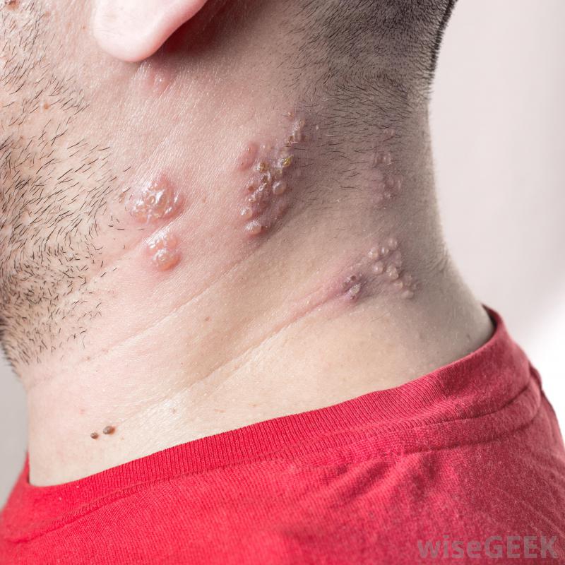 People who suffer from Lichen planus - Health Total