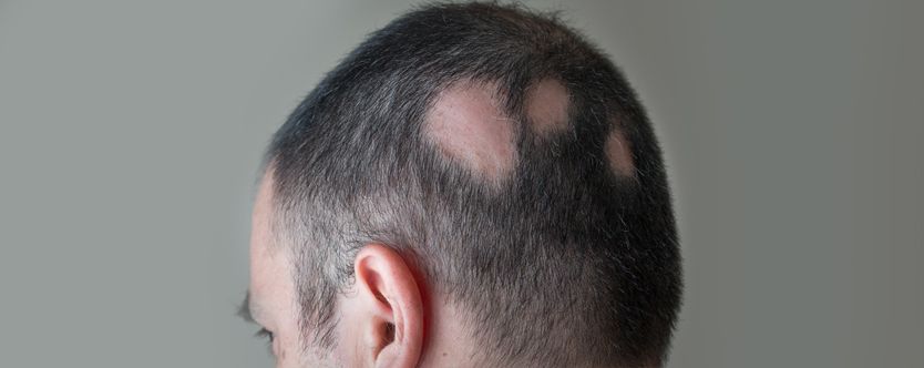 What is Alopecia? Read Reasons and Causes - Health Total