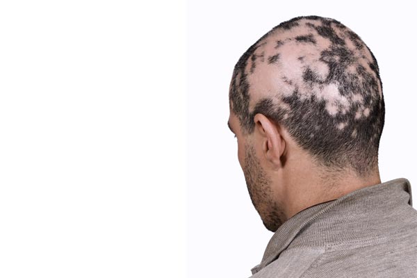 Alopecia Areata Patchy Hair Loss Treatment Homeopathic Remedies At Health Total